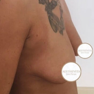 zvetseni-prsou-implantaty-30-pred