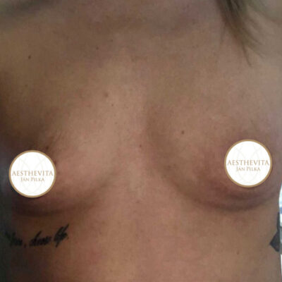 zvetseni-prsou-implantaty-35-pred