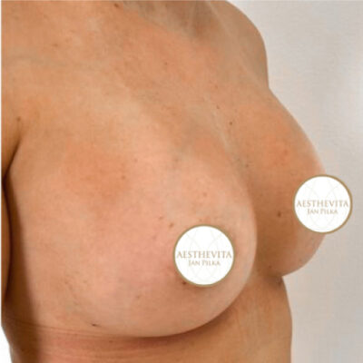 zvetseni-prsou-implantaty-36-po