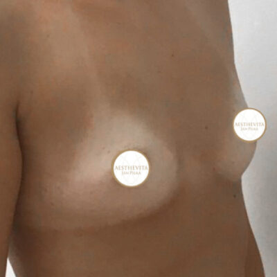 zvetseni-prsou-implantaty-36-pred