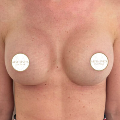 zvetseni-prsou-implantaty-4-po