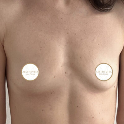 zvetseni-prsou-implantaty-4-pred