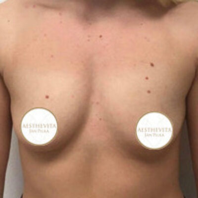 zvetseni-prsou-implantaty-6-pred