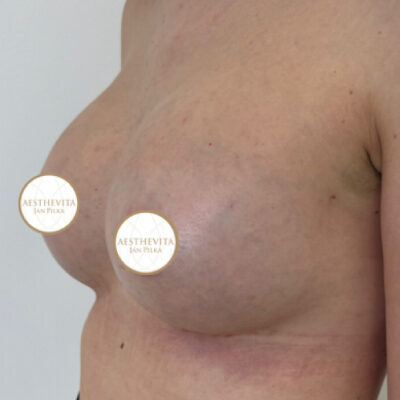 zvetseni-prsou-implantaty-8-po