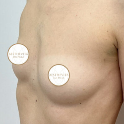 zvetseni-prsou-implantaty-8-pred