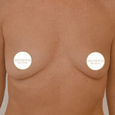 zvetseni-prsou-implantaty-9-pred